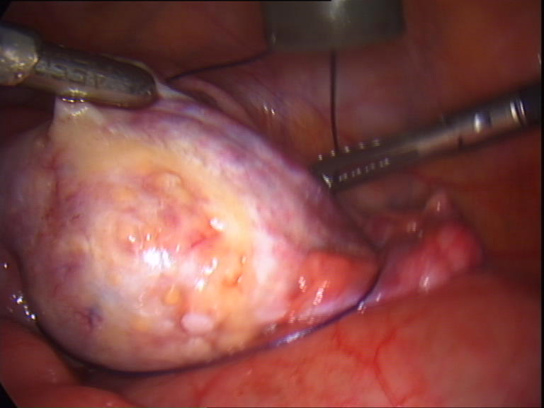 applying loop around ovarian pedicle applying loop around ovarian pedicle